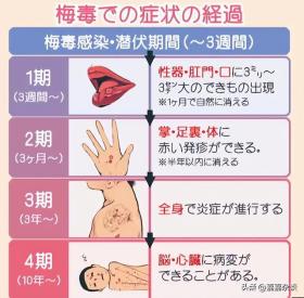 日本梅毒病例激增 东京市政府出手！注意了，在日或者旅日的朋友