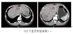 痛心！亲姐刚患癌去世，29岁小伙也确诊癌症晚期！只因忽视了……医生紧急提醒→